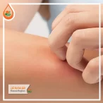دلایل خارش بدن