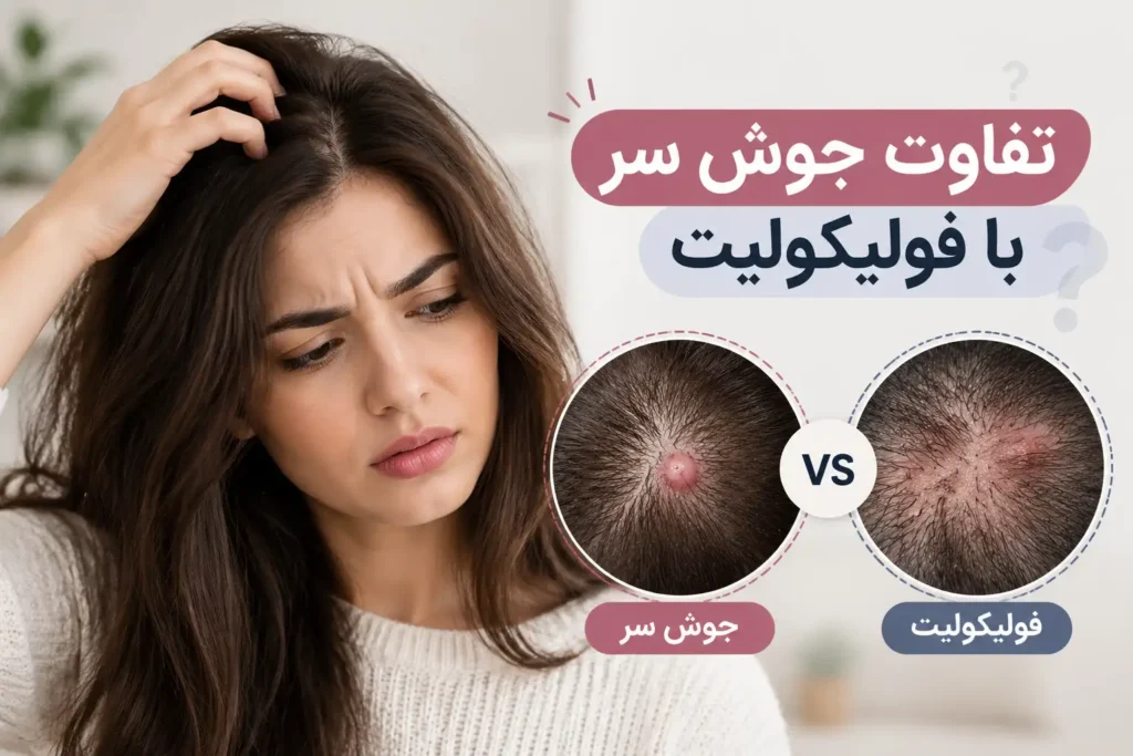 تفاوت جوش سر با فولیکولیت