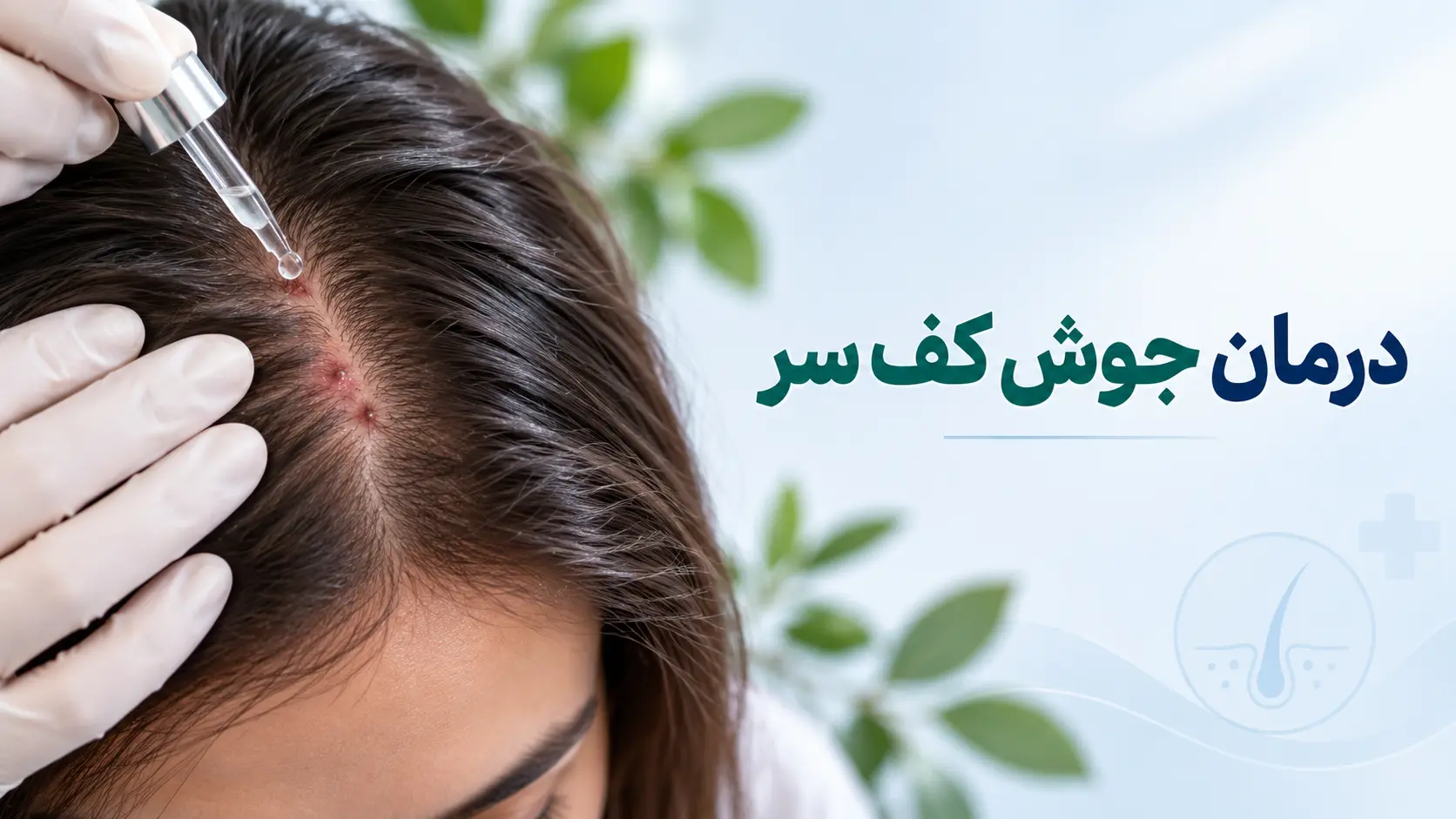 درمان کف سر